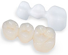 Керамические коронки на зуб (без металла)