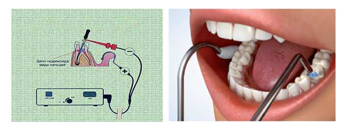 депофорез. безопасный метод лечения корней и каналов зубов