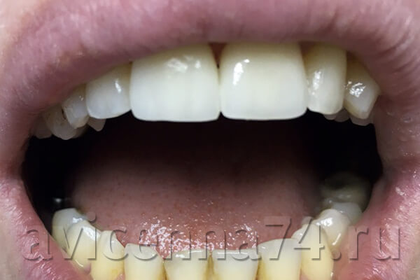 Зубы после установки коронок