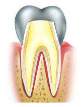 Металлическая коронка на зубе