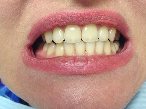 Зубы до отбеливания