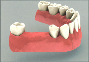 Отсутствие нескольких зубов