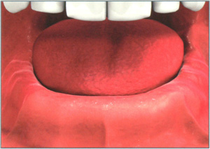 Отсутствие зубов нижней челюсти