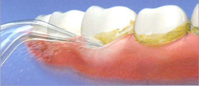 Удаление зубного налета в домашних условиях