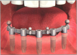 Замещение зубов имплантами
