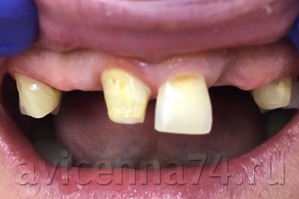 Зубы до установки протезов