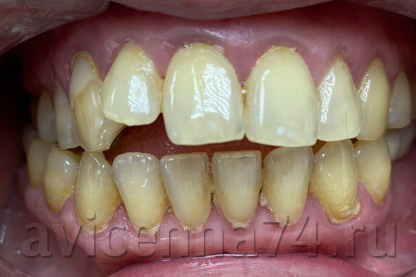 Примеры реставрации зубов (сколы и трещины) фото до и после