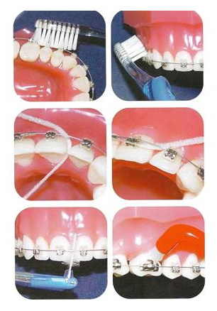 Чистка зубов с брекетами