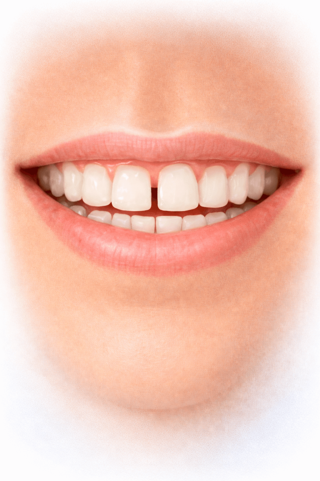 Диастема: что это, почему появляется и как убрать щель между передними зубами