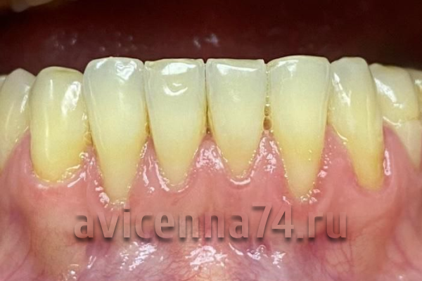 Рецессия десны: фото до