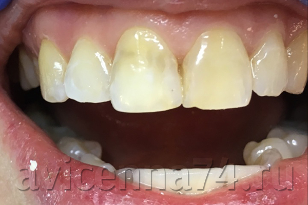 Передние зубы до протезирования