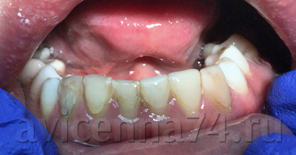 Зубы с дефектами
