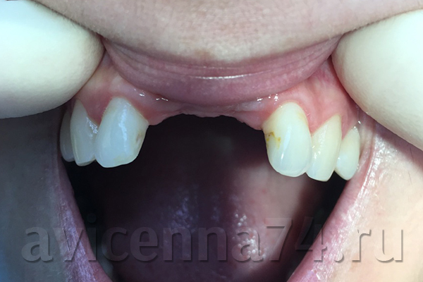 Зубной ряд до восстановления передних зубов