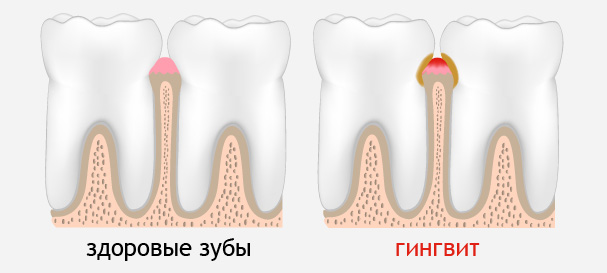Здоровые зубы и гингивит: фото