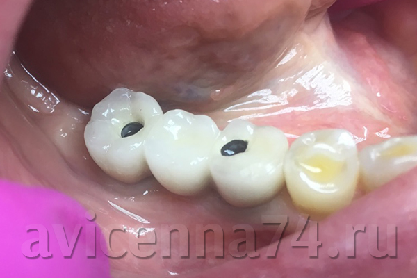 Зубы после установки протеза на имплантах