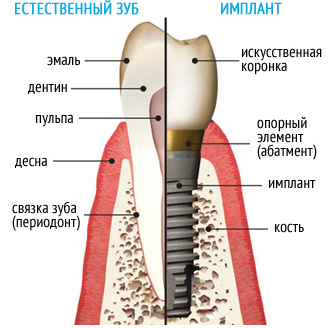 Сравнение зуба и импланта, чем они отличаются