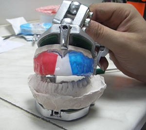 Изготовление индивидуальной капы для зубов