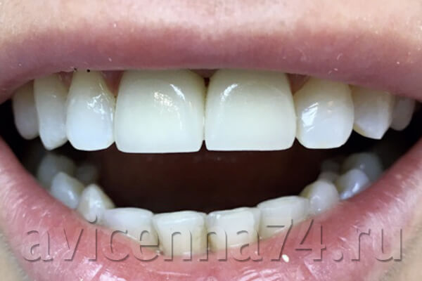 Зубы после установки коронок из пресс-керамики