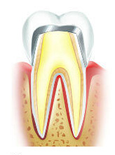 Металлокерамическая коронка на зубе