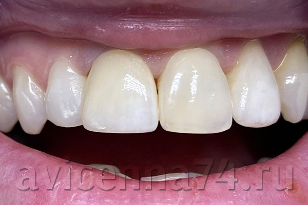 Зубы после установки коронки из оксида циркония