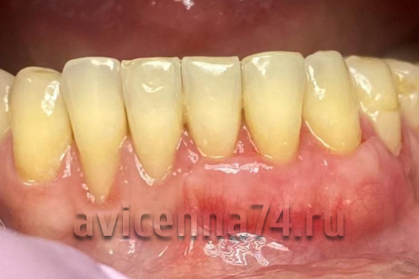 Рецессия десны: фото после