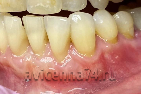 Рецессия десны: фото после