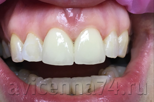 Передние зубы после протезирования