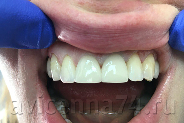 Протезирование зубов: фото до и после
