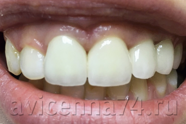 Протезирование зубов с помощью керамики из диоксида циркония
