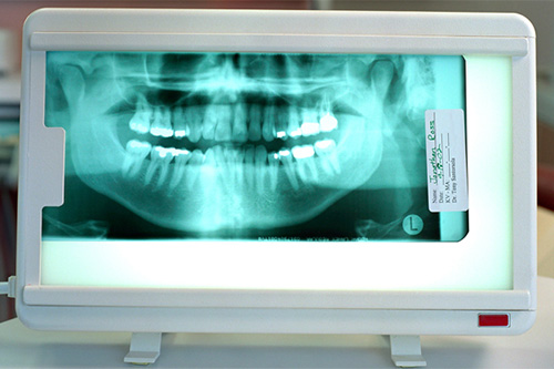 Панорамный снимок зубов