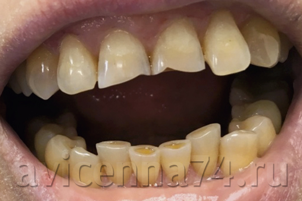 Реставрация зубов: фото до и после