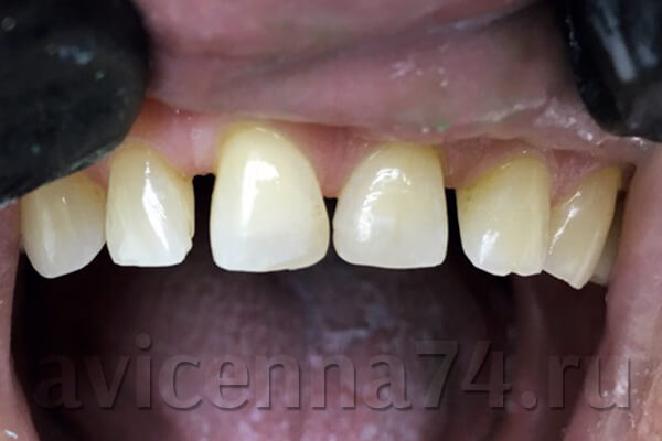 Зубы после эстетической реставрации
