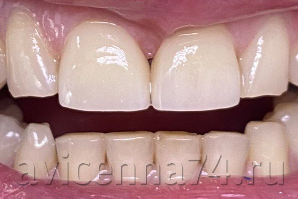Закрытие диастемы между зубами