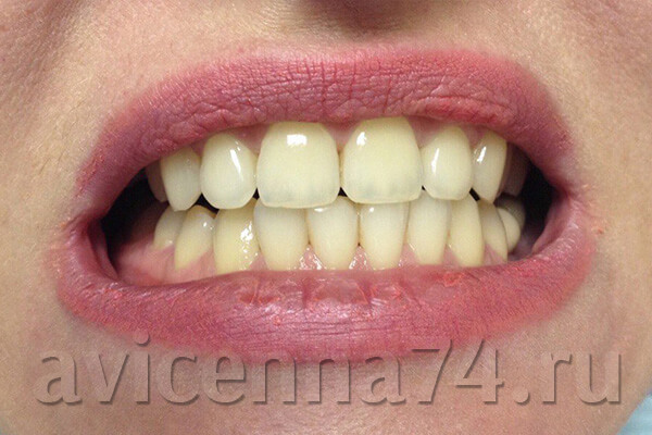 Гигиена и отбеливание зубов: фото до и после