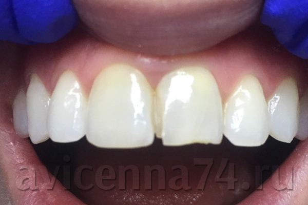 Установка виниров на зубы: фото до и после