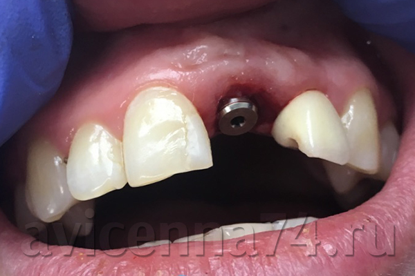 Зубы до установки импланта