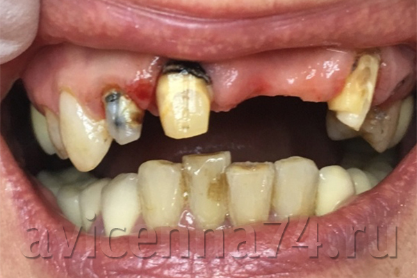 Зубы до замены моста из металлокерамики
