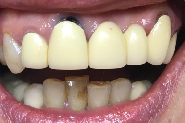 Зубы до замены мостовидного протеза