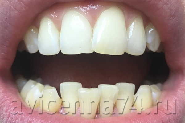 Зубы после гигиенической чистки