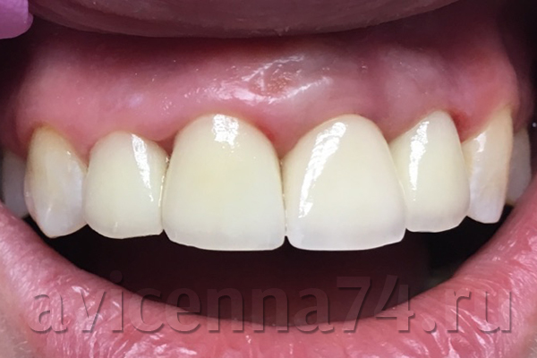Зубы после установки импланта