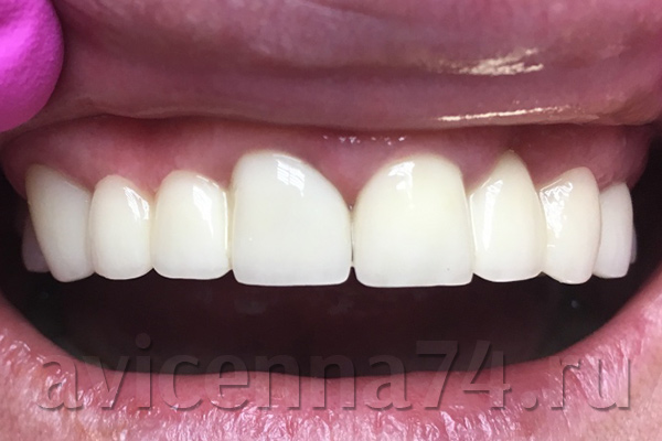 Зубы после установки протезов и коронок