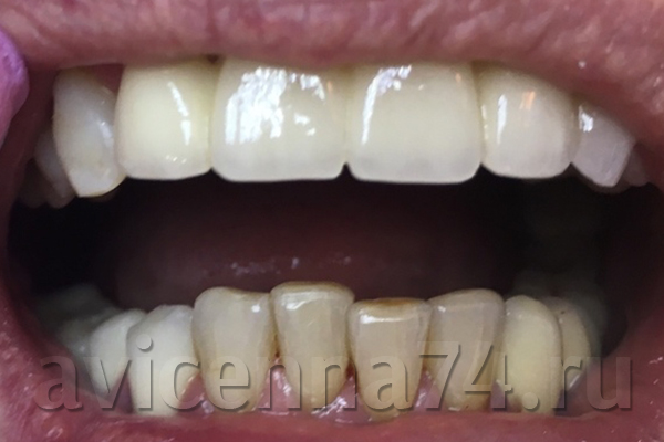Зубы после замены моста из металлокерамики